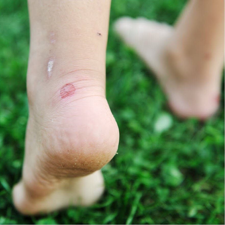 Deroofed Blisters: Here's What You Need To Know - Blister Prevention -  Rebecca Rushton