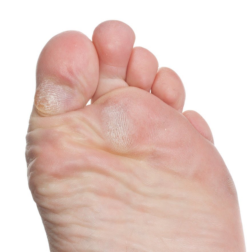 Hard skin clearance under feet remedy