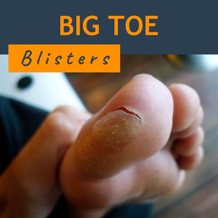 Blister shop under toe