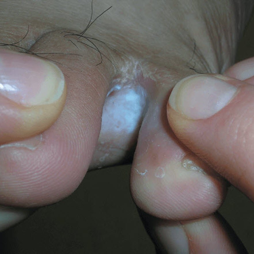 Yeast on sale infection blister