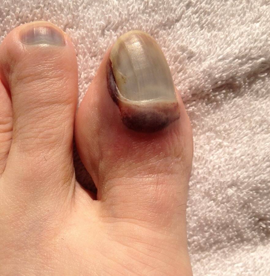 http://www.blister-prevention.com/cdn/shop/articles/big-toe-toenail-blister-blood-black.jpg?v=1682666679&width=2048