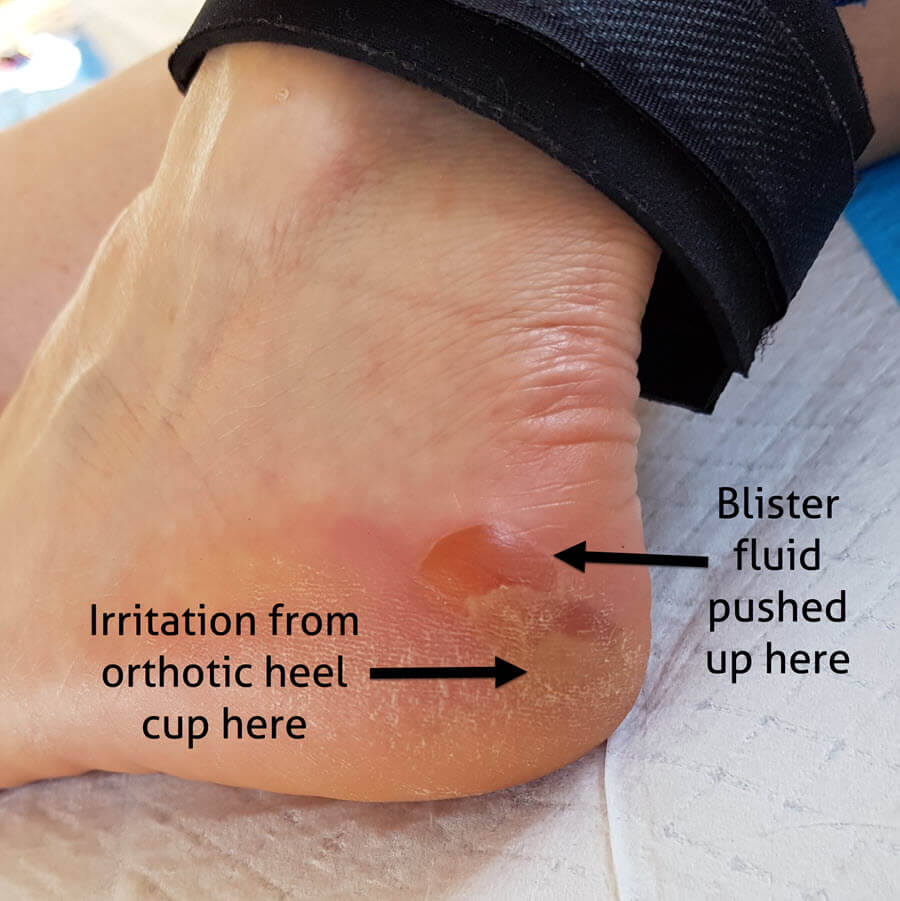 Blister on store heel