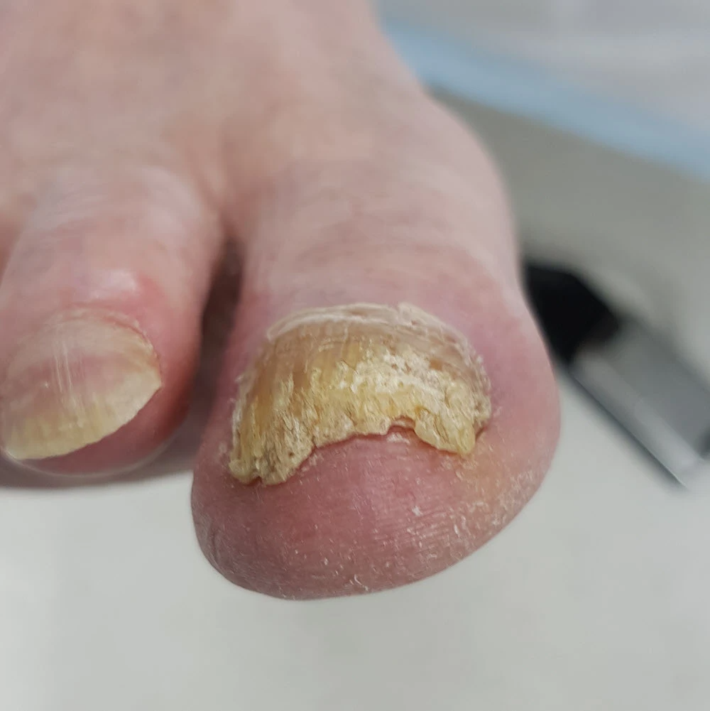 Thick Toenails Cause Symptoms Treatment