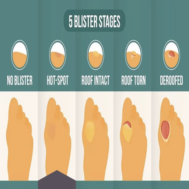 Blister Hot Spot | Hot Spot On Foot: A Pre-Blister State