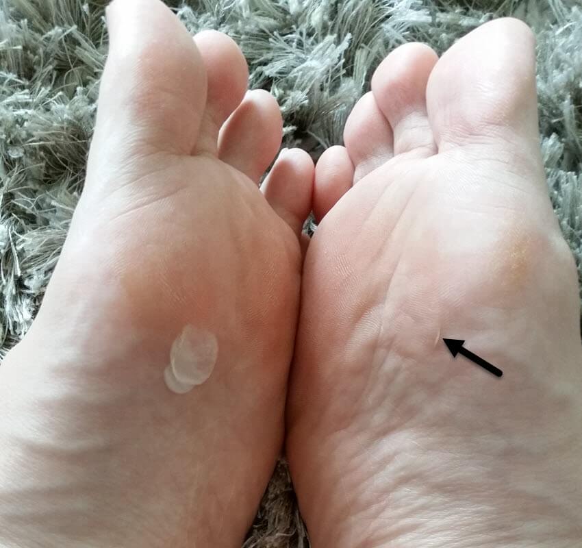 Buy Sole Mates - Cracked Heel Healers You can begin healing painful cracks  and rough, dry heels instantly Don't mess with lotions and pedicures-- heal  your cracked skin naturally from the inside