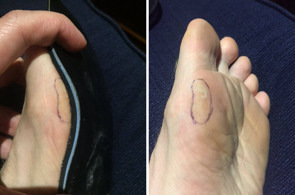 Bunions And Blisters: A Comprehensive Guide - Blister Prevention - Rebecca  Rushton