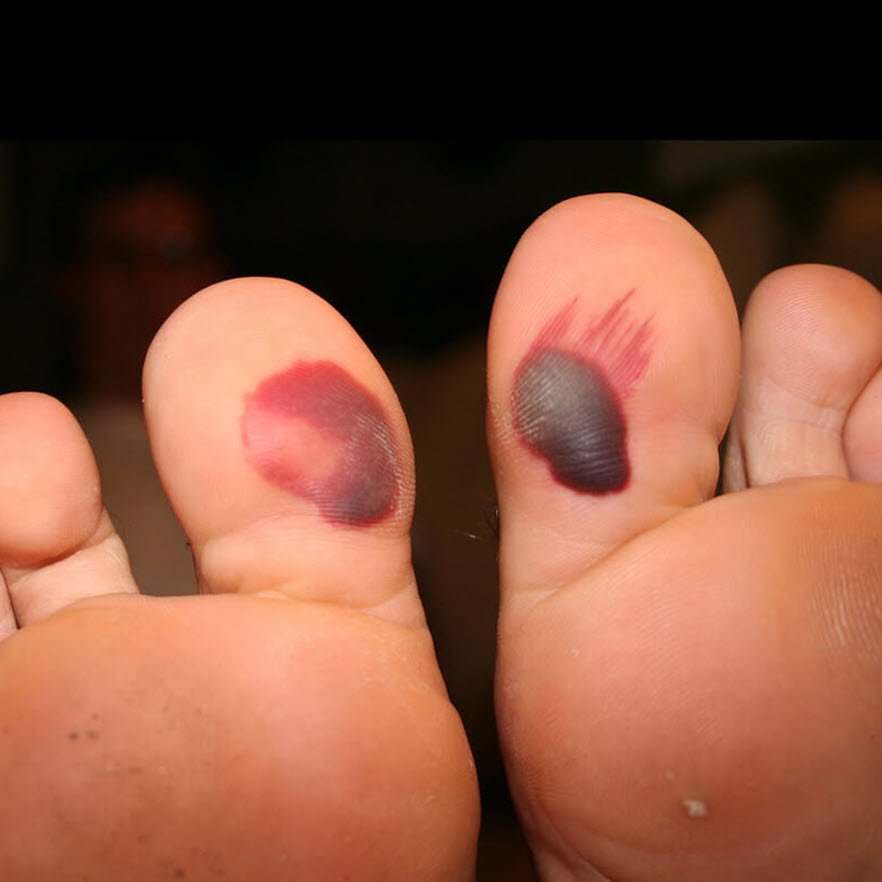 blood-blister-on-foot-do-s-and-don-ts-blister-prevention