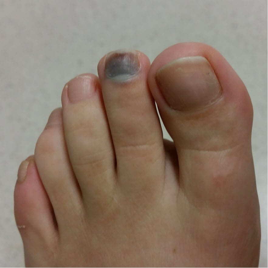 Black Toenail Treatment Causes Prevention Blister Prevention