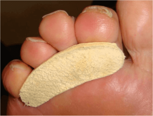 Blisters On Tips Of Toes Causes Prevention And Treatment 2140