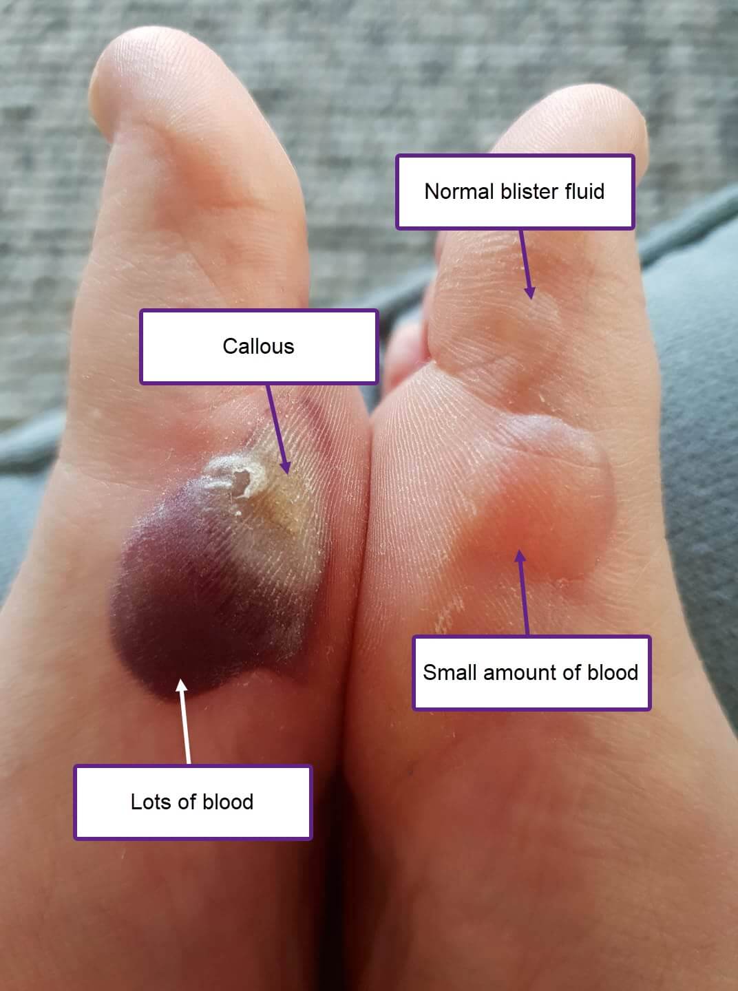 How To Deal With Blood Blisters On Feet