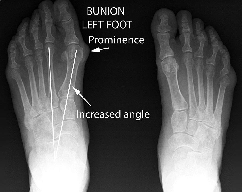 Bunions And Blisters: A Comprehensive Guide - Blister Prevention